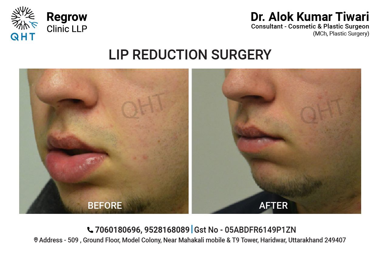 lip-reduction-qht