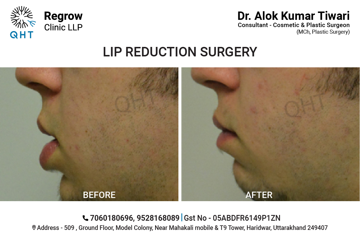 lip-reduction-qht