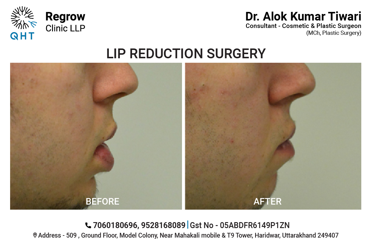 lip-reduction-qht