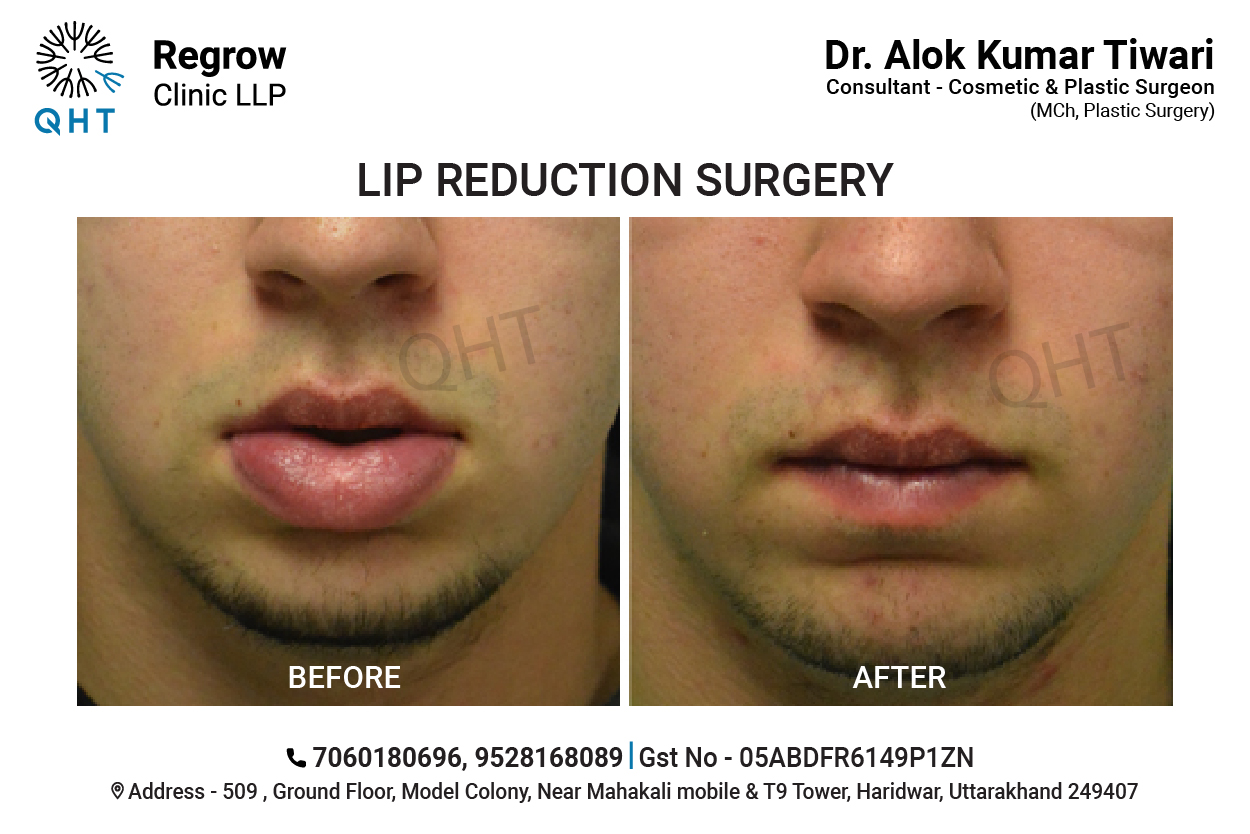 lip-reduction-qht