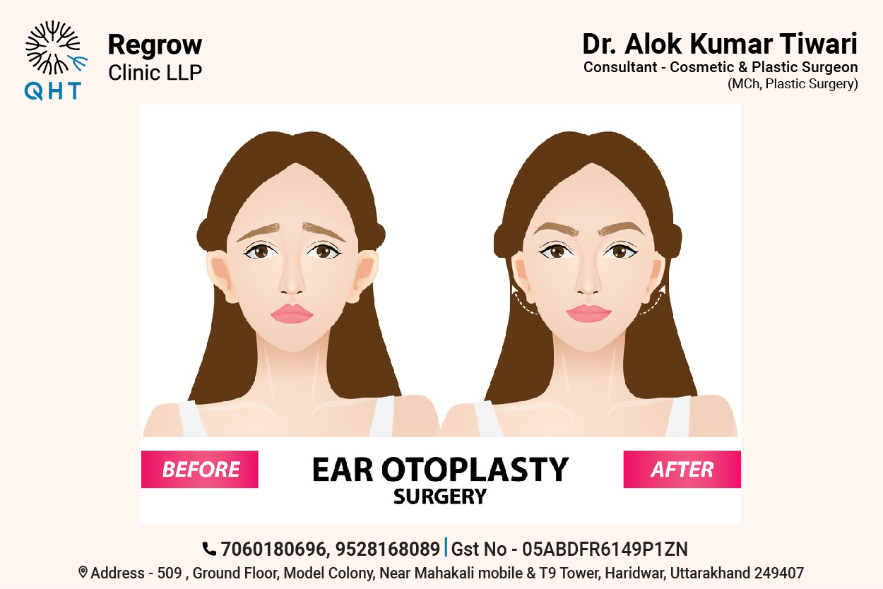 ear-otoplasty-qht