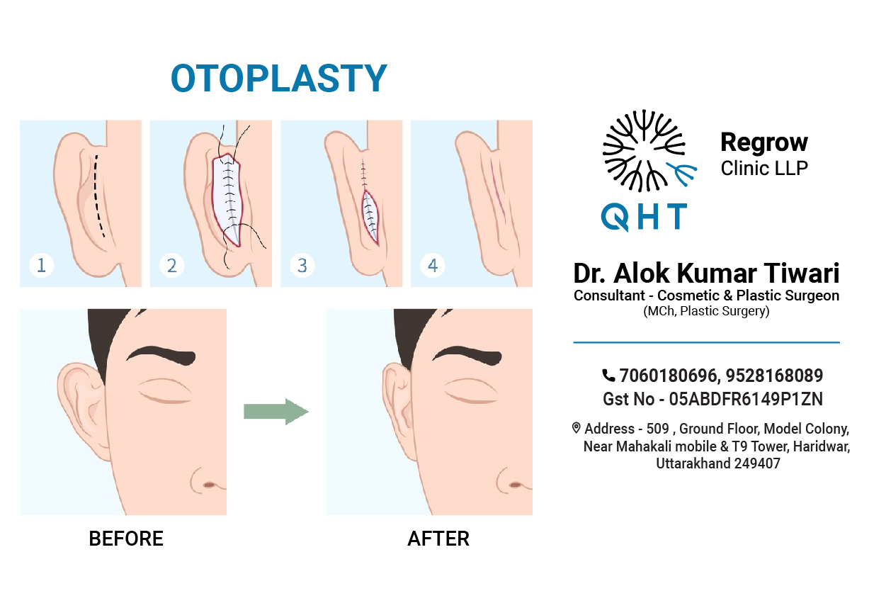 otoplasty-qht