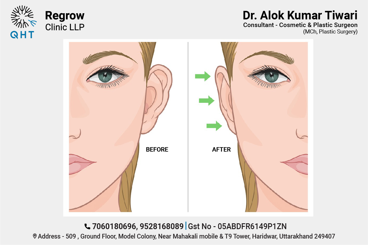 ear-otoplasty-qht