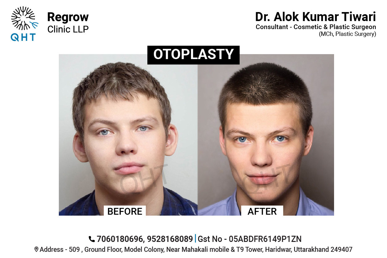 OTOPLASTY-QHT