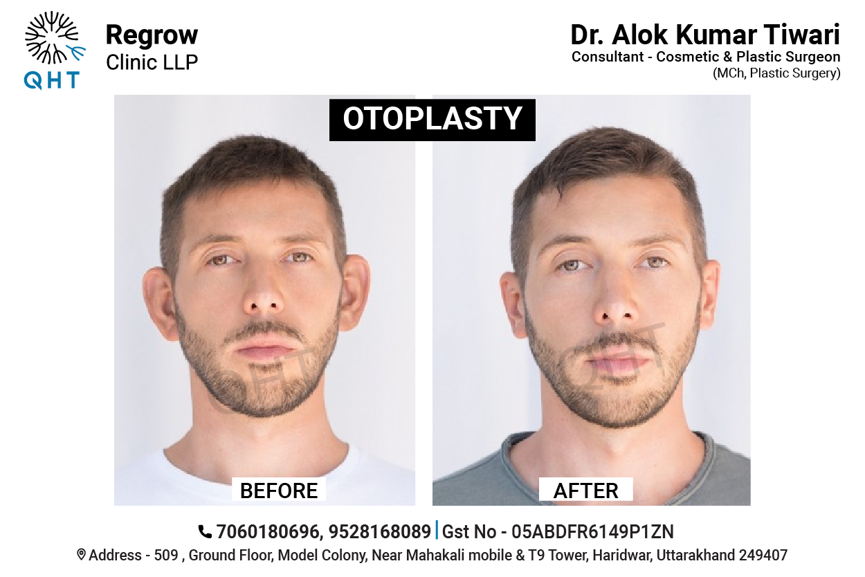 OTOPLASTY-QHT