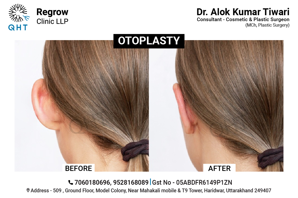 OTOPLASTY-QHT