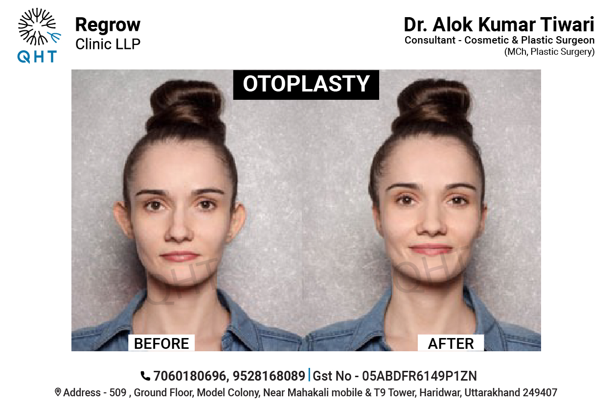 OTOPLASTY-QHT