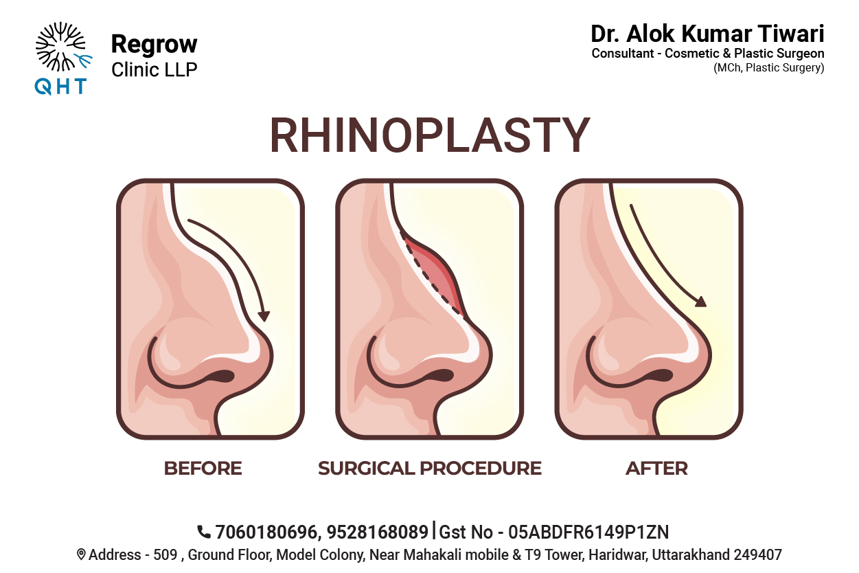 before-after-rhinoplasty-qht