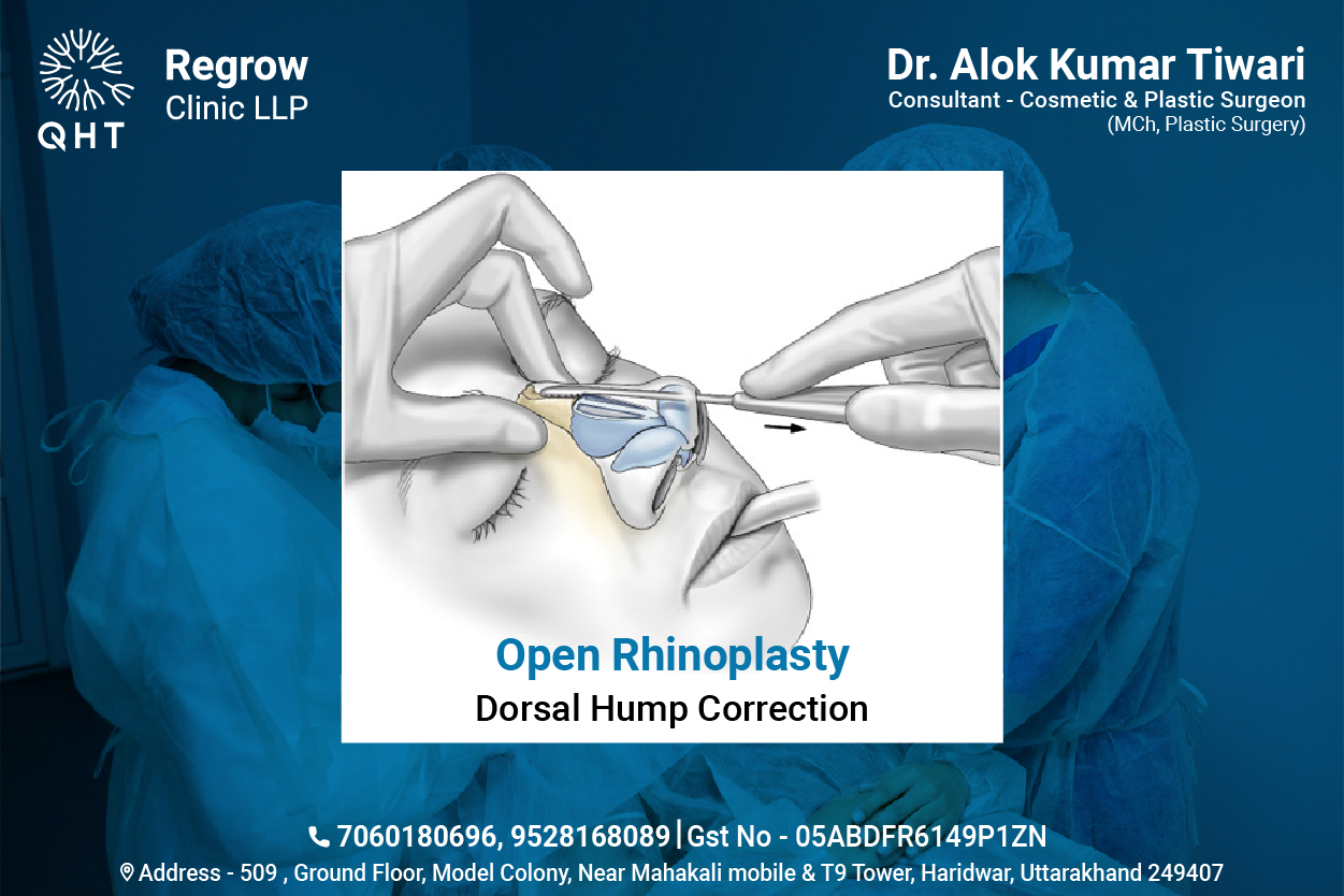 open-rhinoplasty-qht