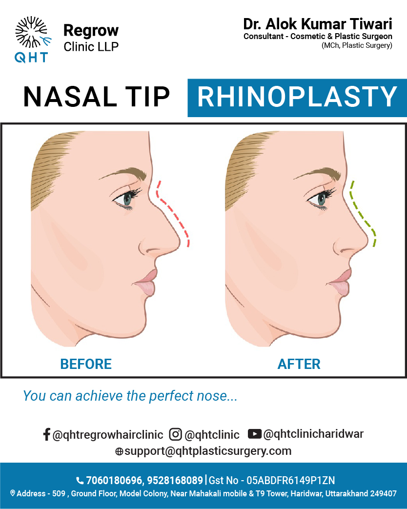 nasal-tip-rhinoplasty-qht