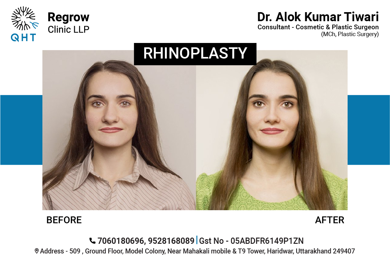 Rhinoplasty-qht