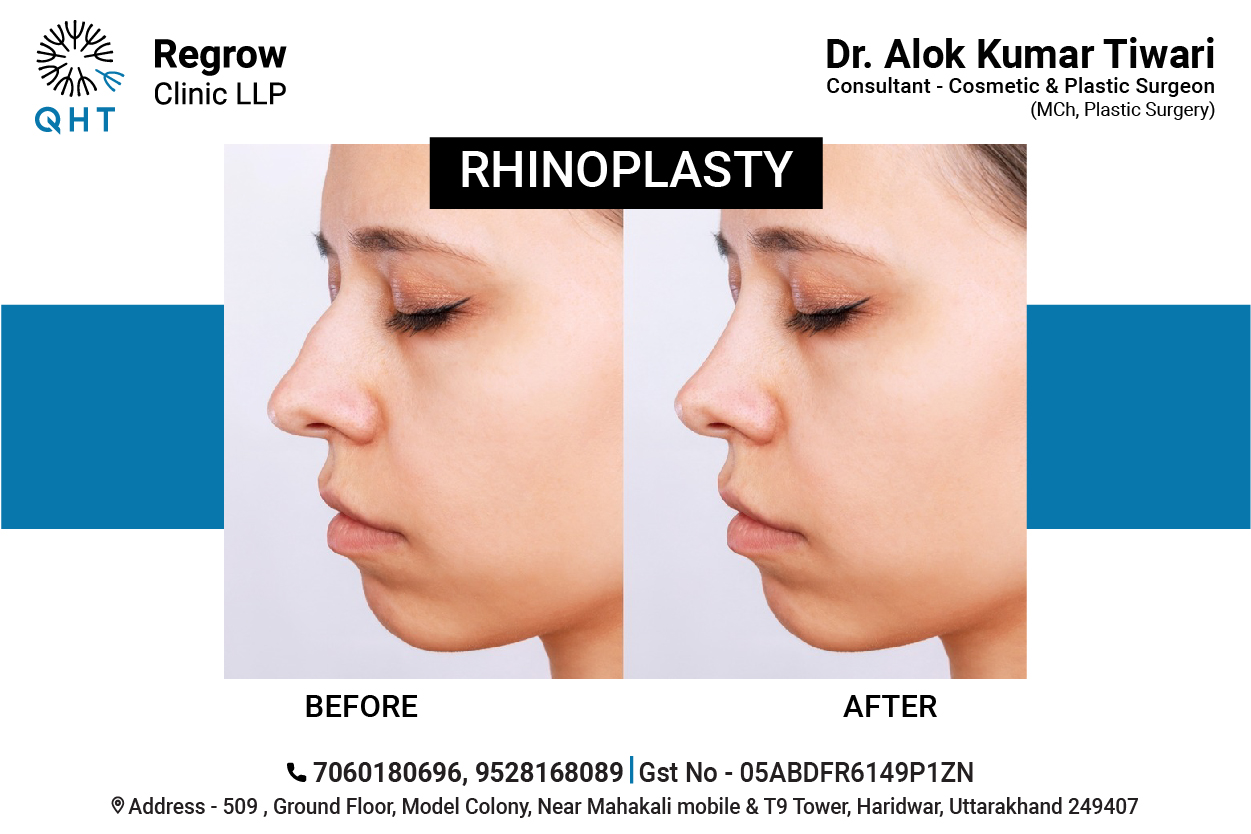 Rhinoplasty-qht