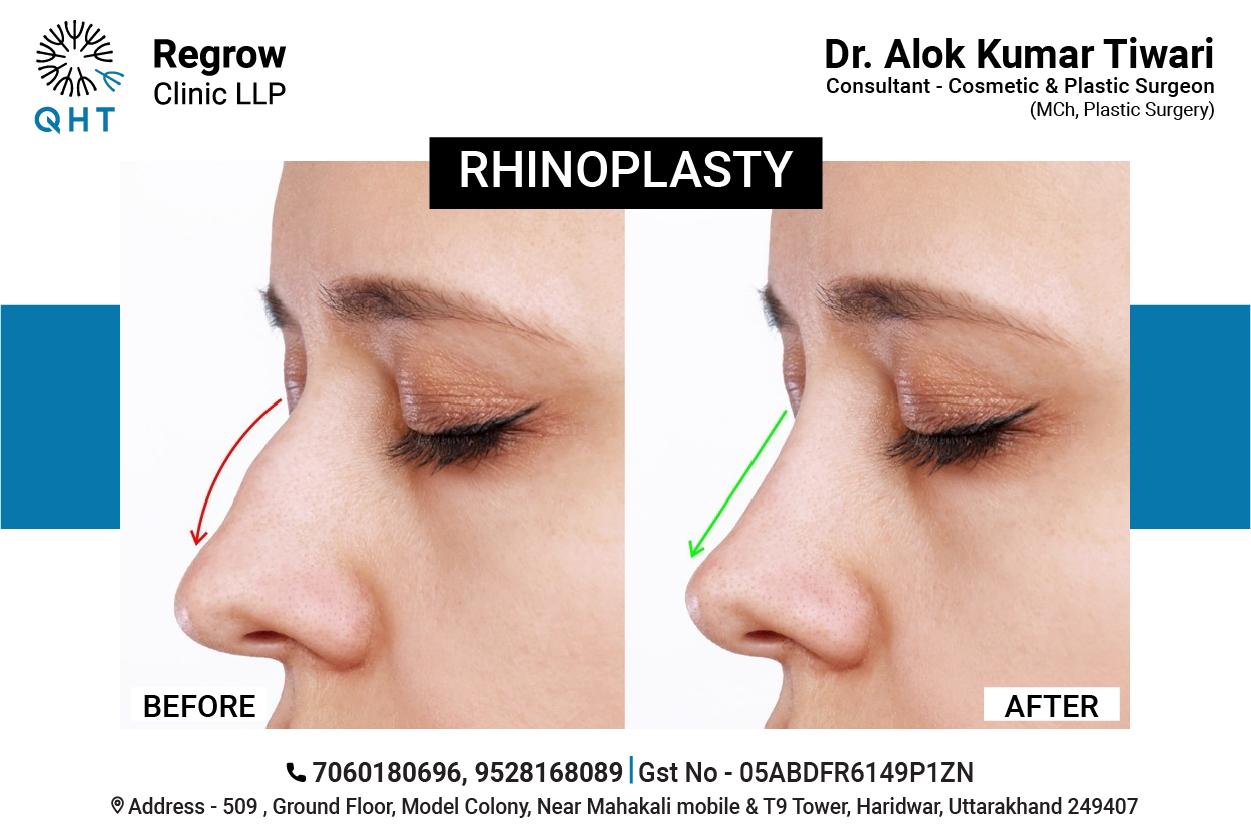 Rhinoplasty-qht