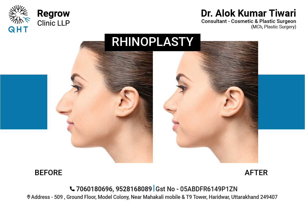 Rhinoplasty-qht