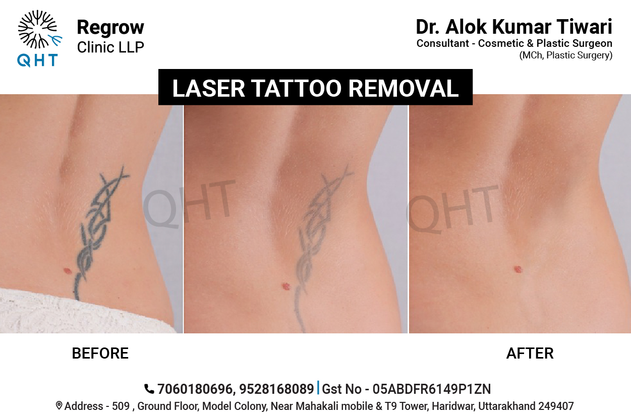 laser-tattoo-removal-qht