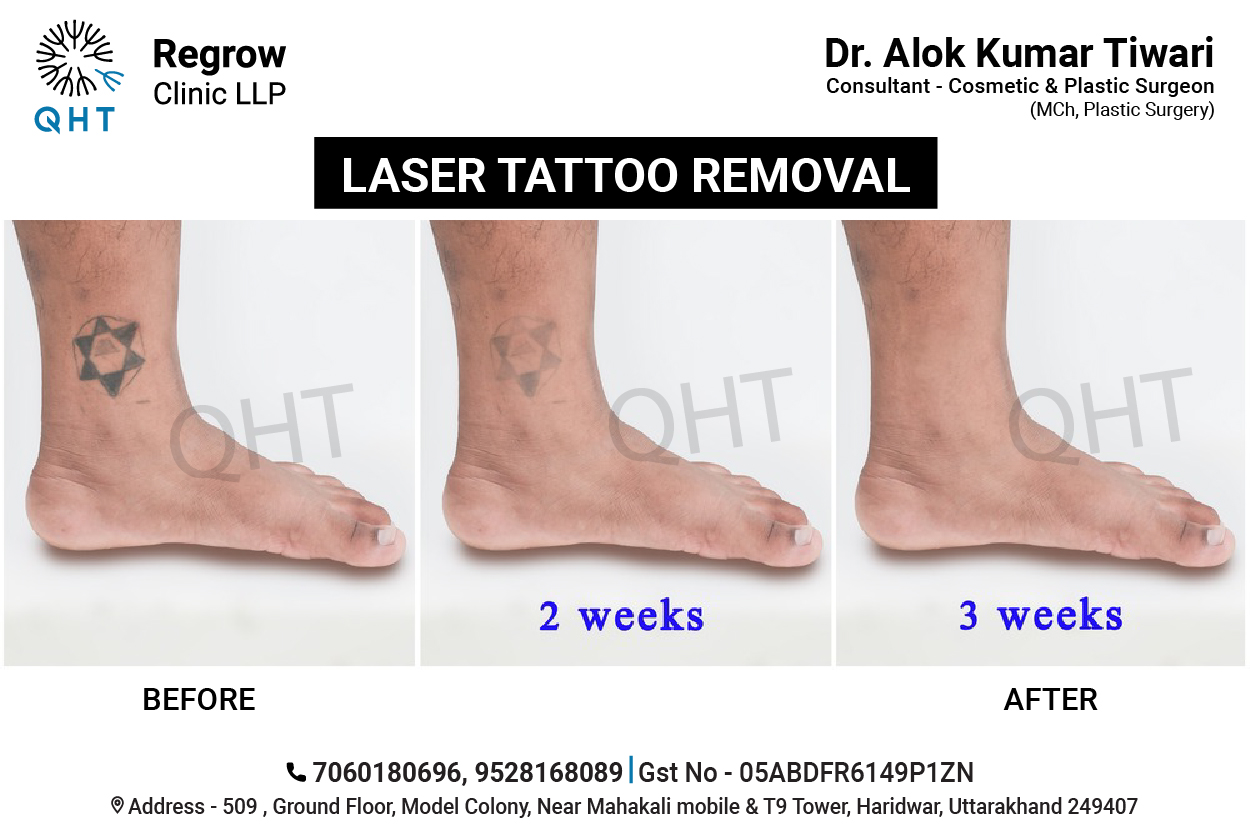 laser-tattoo-removal-qht