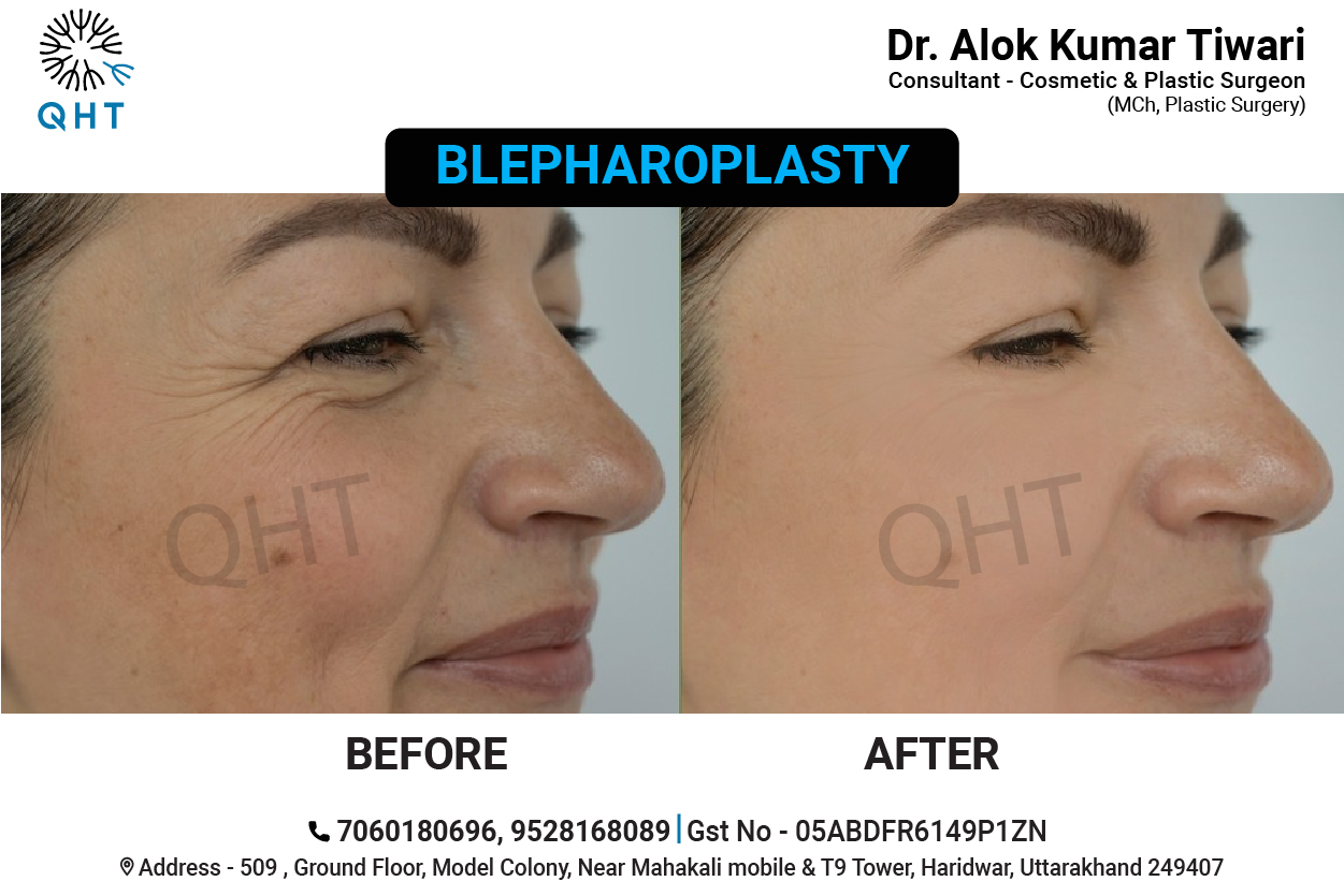 BLEPHAROPLASTY-QHT