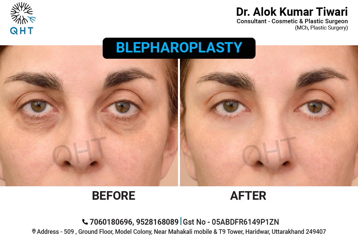 BLEPHAROPLASTY-QHT