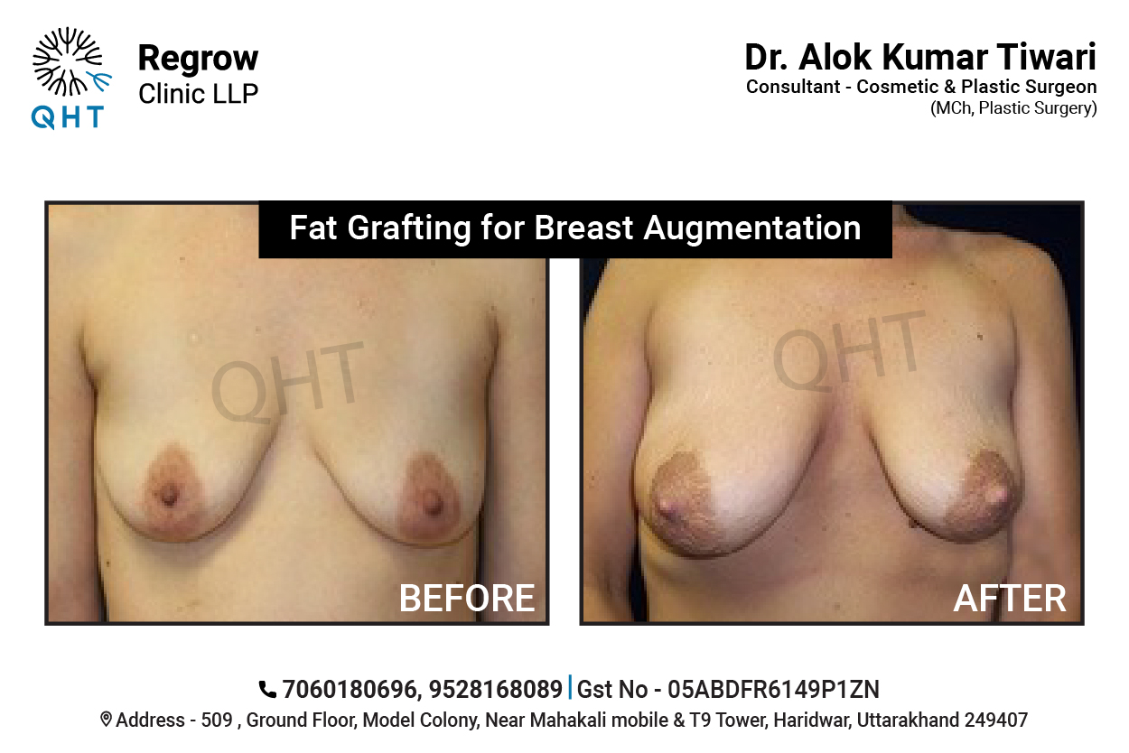 breast-lift-qht