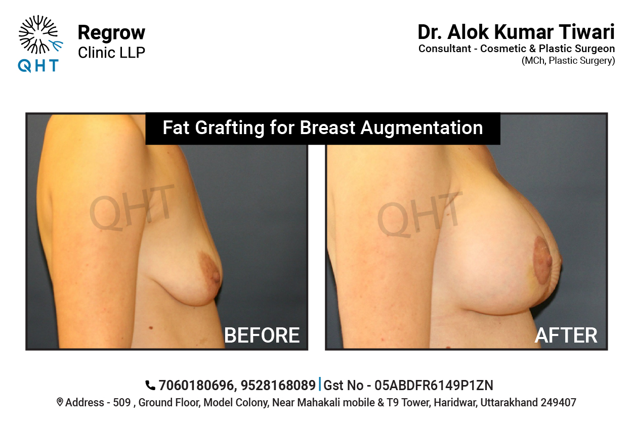 breast-lift-qht