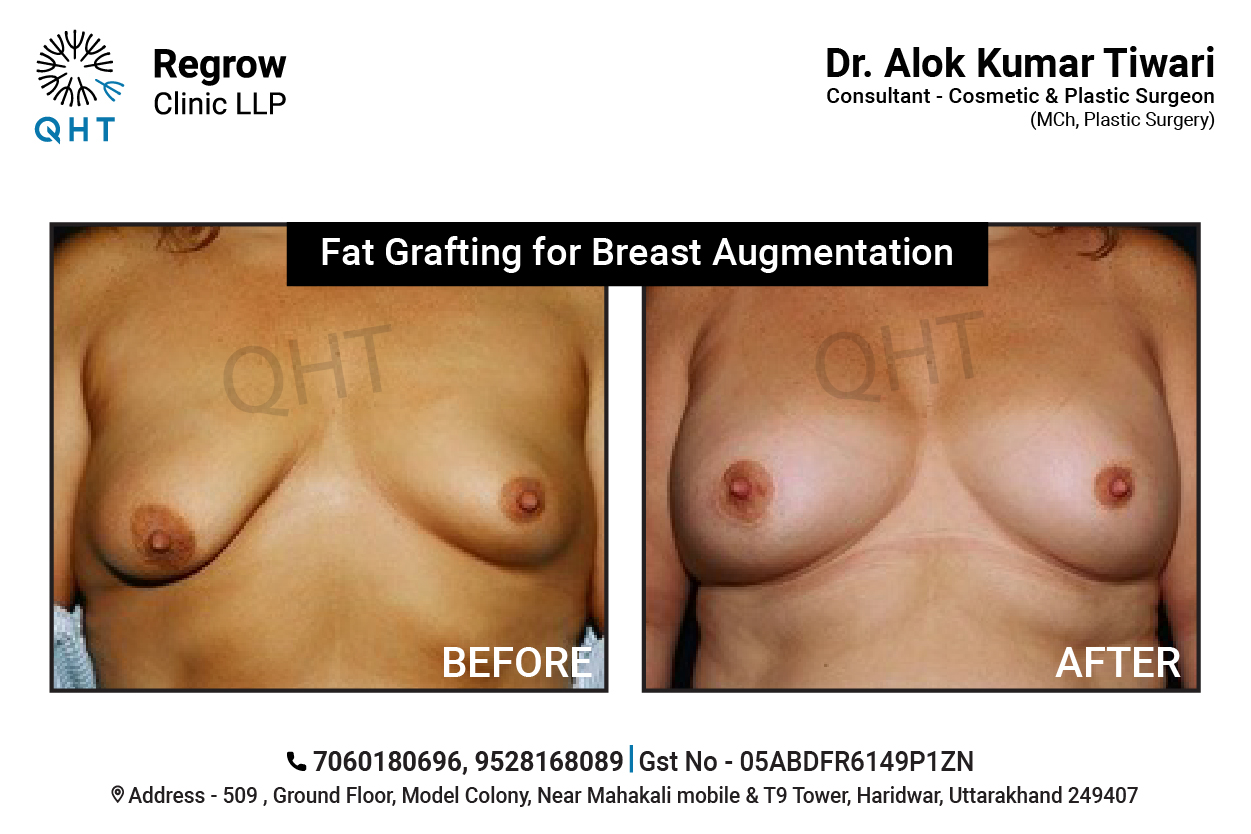 breast-lift-qht