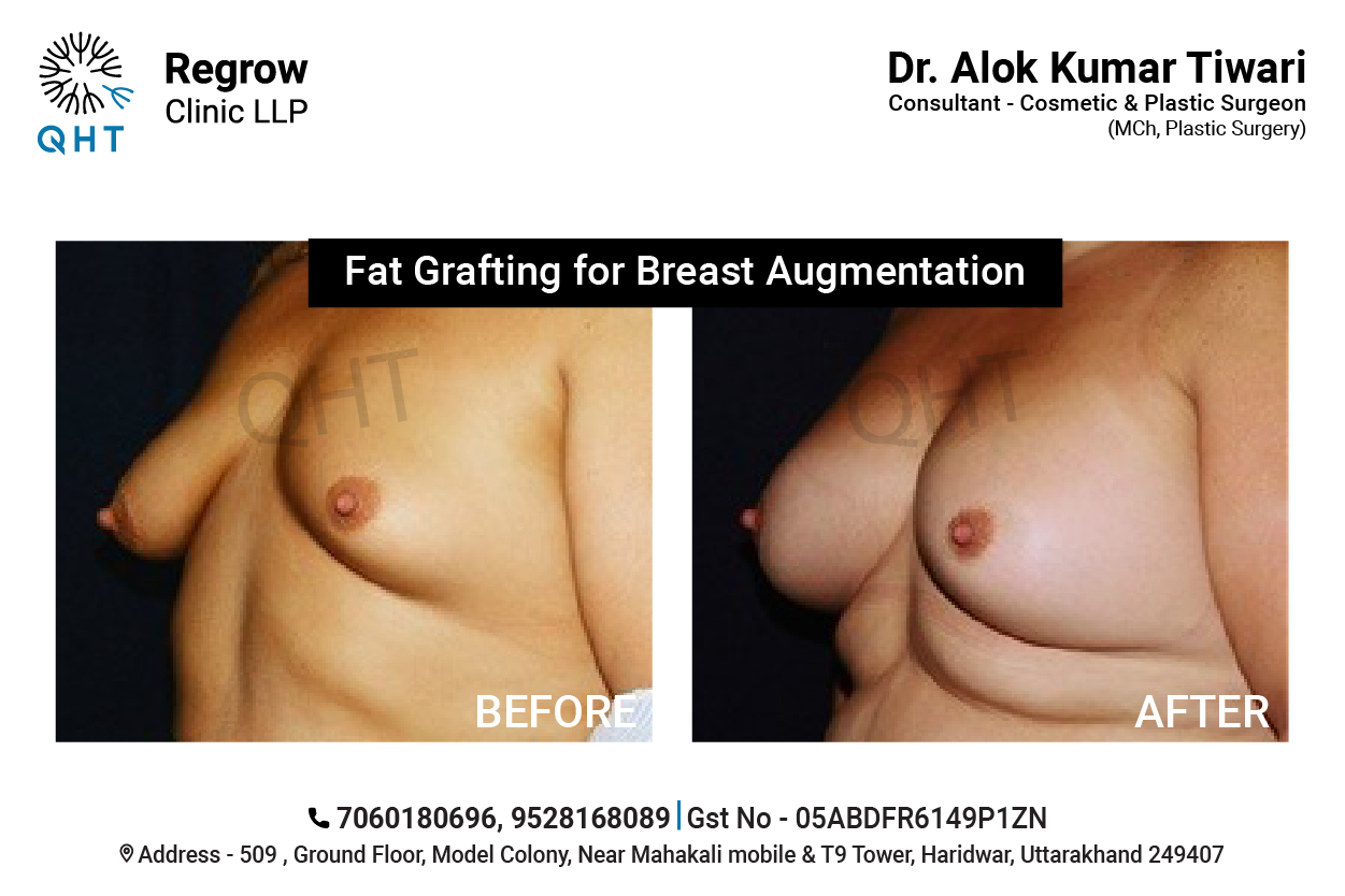 breast-lift-qht