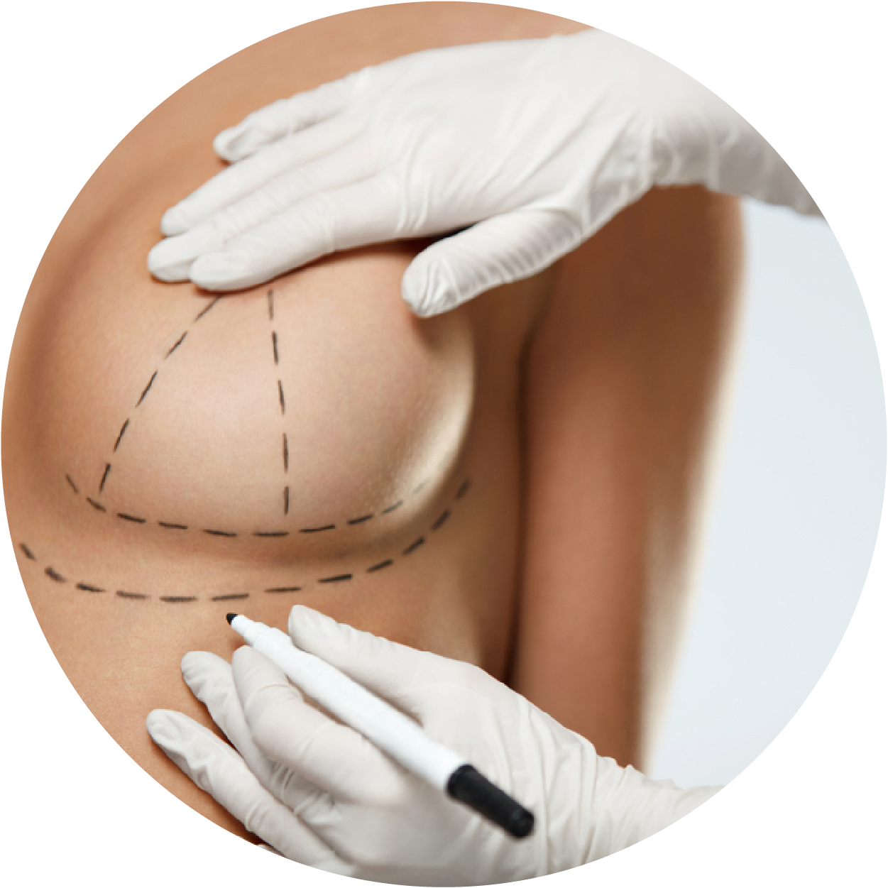 fat-transfer-for-breast-augmentation-qht